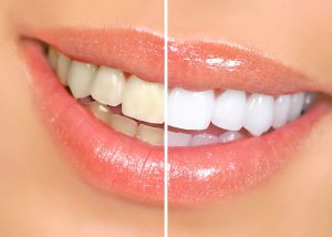 lambourn-teeth-whitening