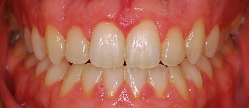 Crowding_with_Underbite_117_Days_AFTER Crowding_with_Underbite_117_Days_AFTER
